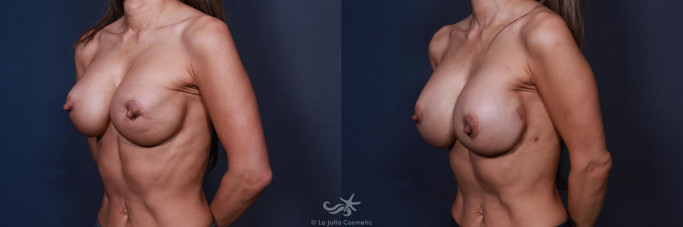 Before & After Breast Implant Replacement Result 214 Left Oblique View in San Diego, CA