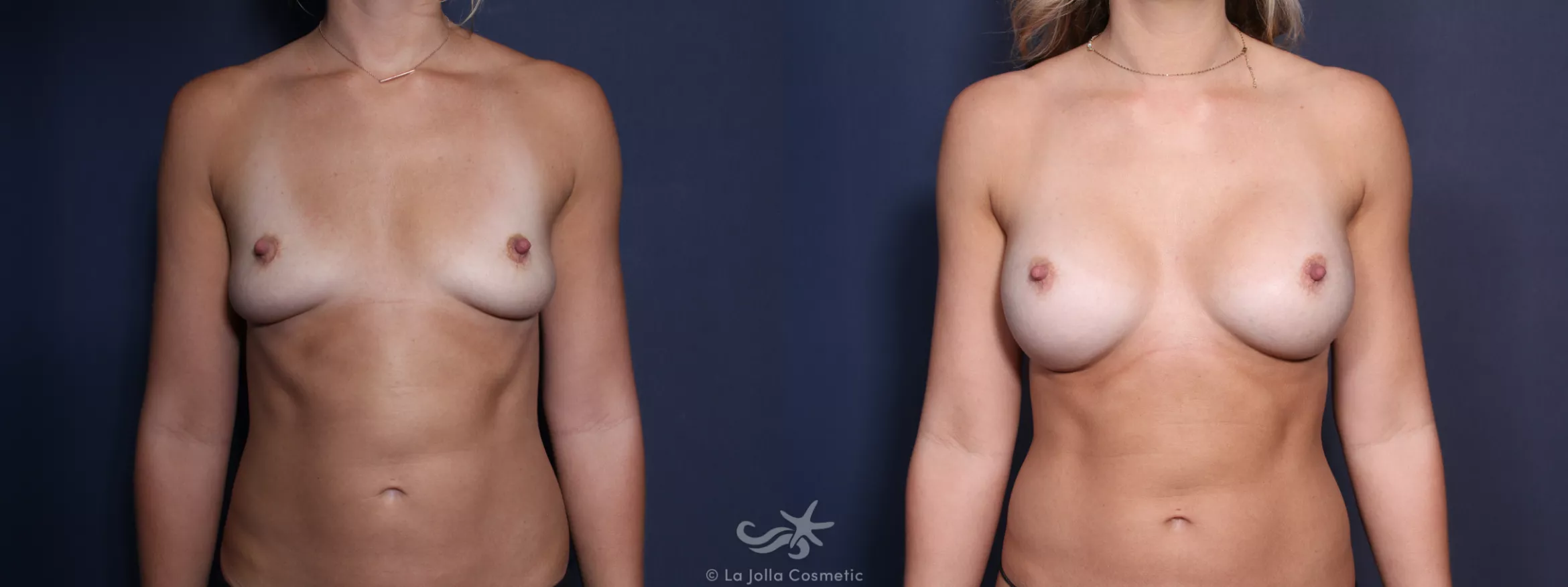Before & After Breast Implant Replacement Result 22 Front View in San Diego, CA
