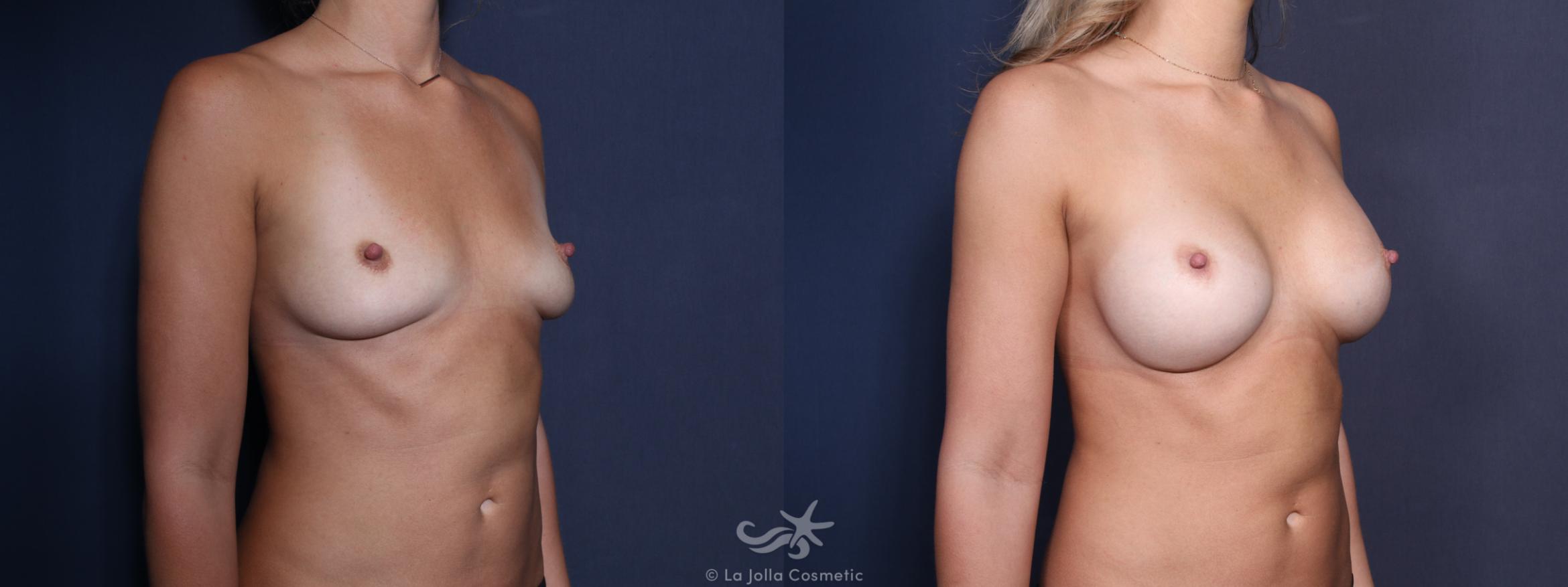 Before & After Breast Implant Replacement Result 22 Right Oblique View in San Diego, CA