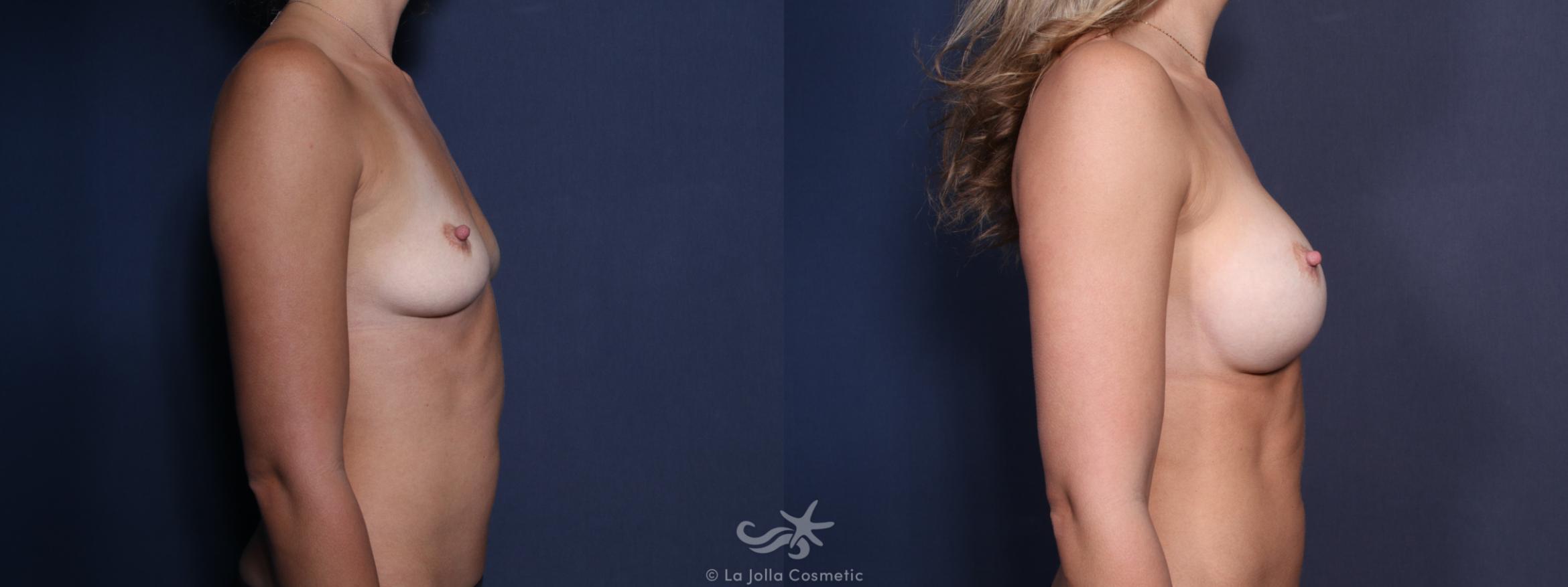 Before & After Breast Implant Replacement Result 22 Right Side View in San Diego, CA