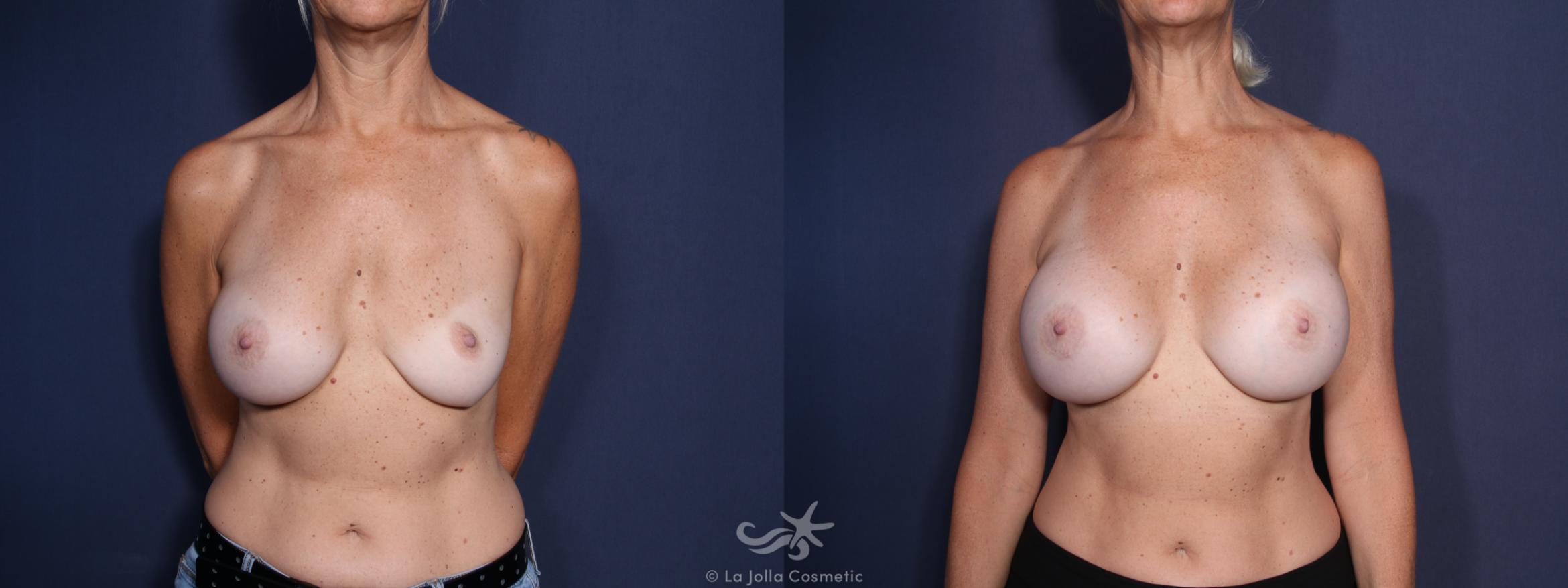 Before & After Breast Implant Replacement Result 47 Front View in San Diego, CA