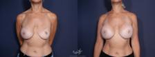 Before & After Breast Implant Replacement Result 47 Front View in San Diego, Carlsbad, CA