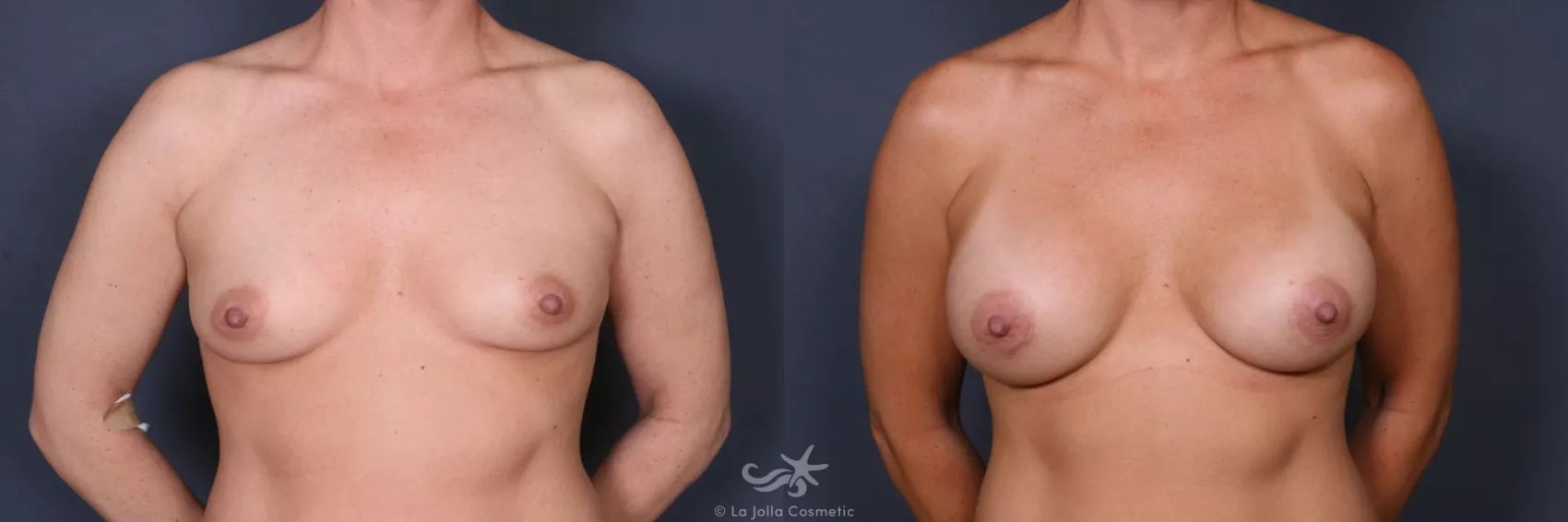 Before & After Breast Implant Replacement Result 490 Front View in San Diego, CA