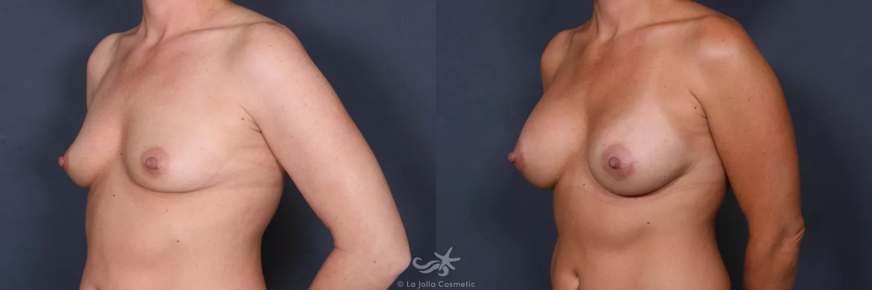 Before & After Breast Implant Replacement Result 490 Left Oblique View in San Diego, CA