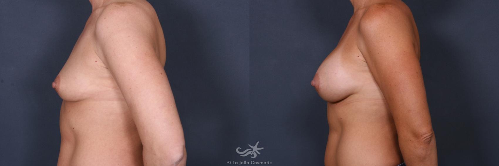 Before & After Breast Implant Replacement Result 490 Left Side View in San Diego, CA