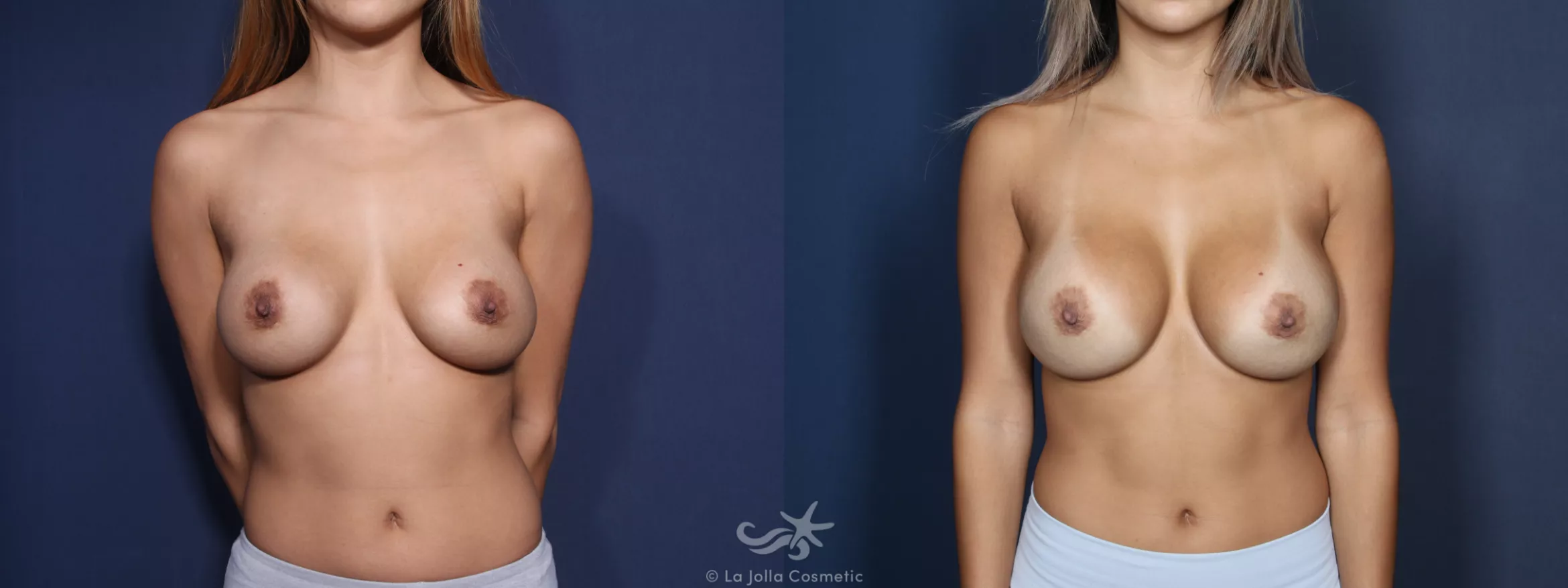Before & After Breast Implant Replacement Result 51 Front View in San Diego, CA