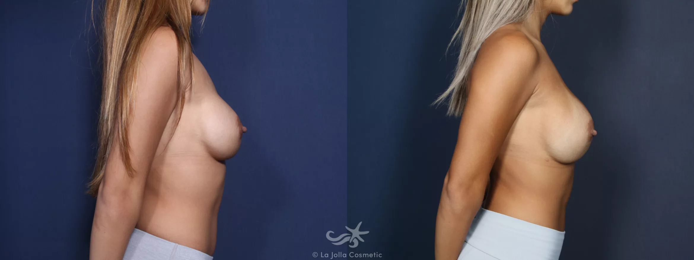 Before & After Breast Implant Replacement Result 51 Right Side View in San Diego, CA