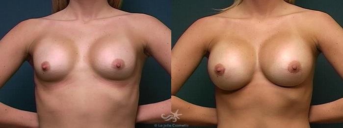 Before & After Breast Implant Replacement Result 527 Front View in San Diego, Carlsbad, CA