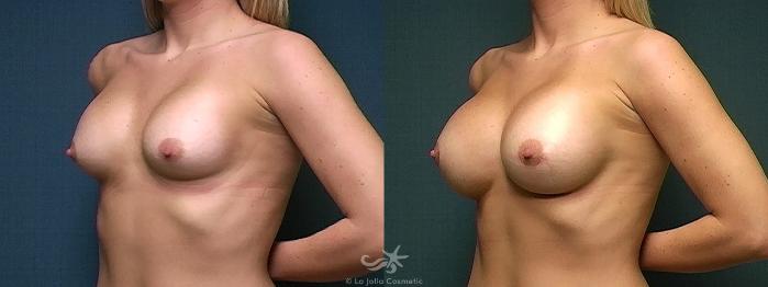 Before & After Breast Implant Replacement Result 527 Left Oblique View in San Diego, Carlsbad, CA
