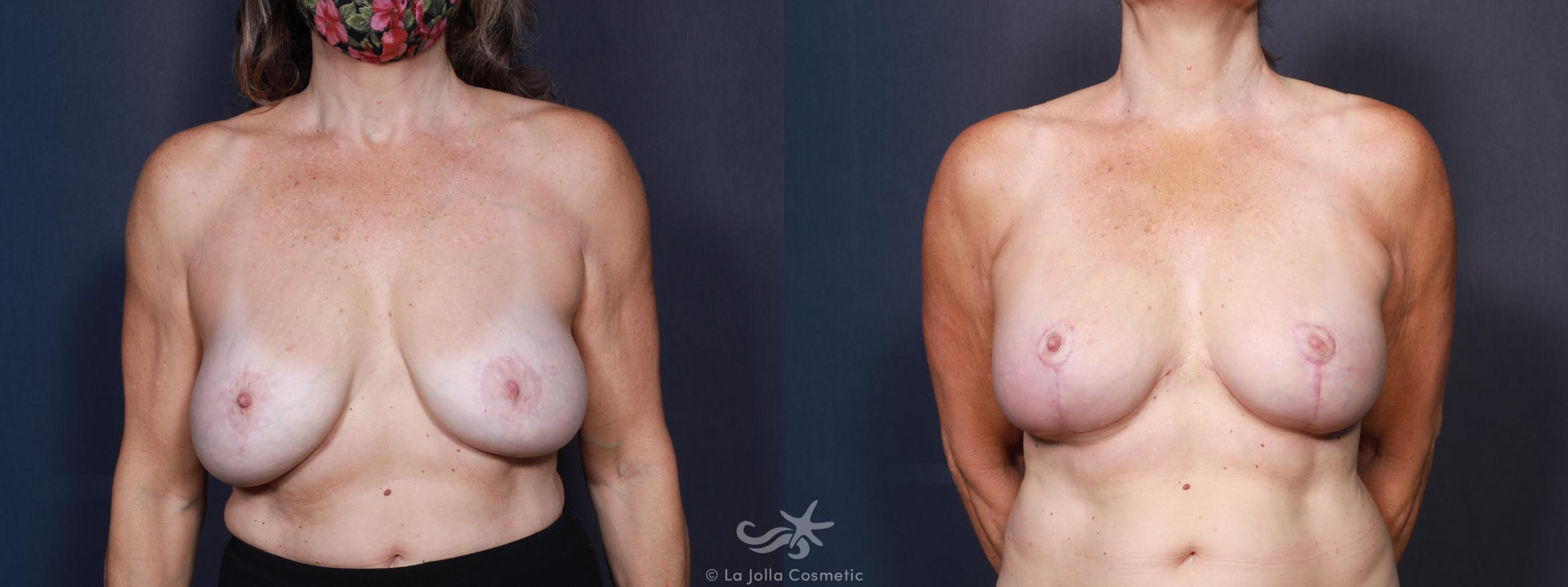 Before & After Breast Augmentation with Lift Result 611 Front View in San Diego, CA