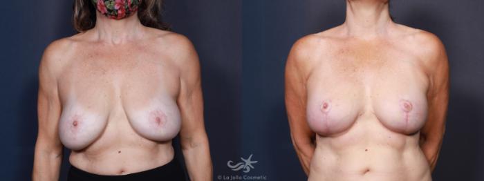 Before & After Breast Lift Result 611 Front View in San Diego, Carlsbad, CA
