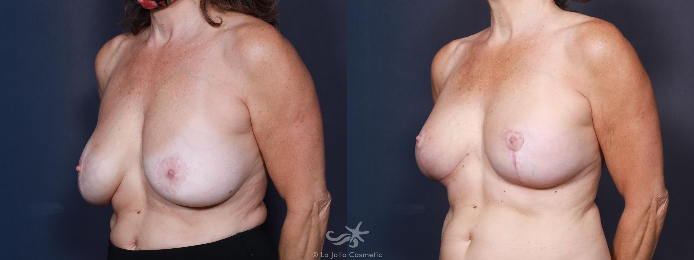 Before & After Breast Implant Replacement Result 611 Left Oblique View in San Diego, CA