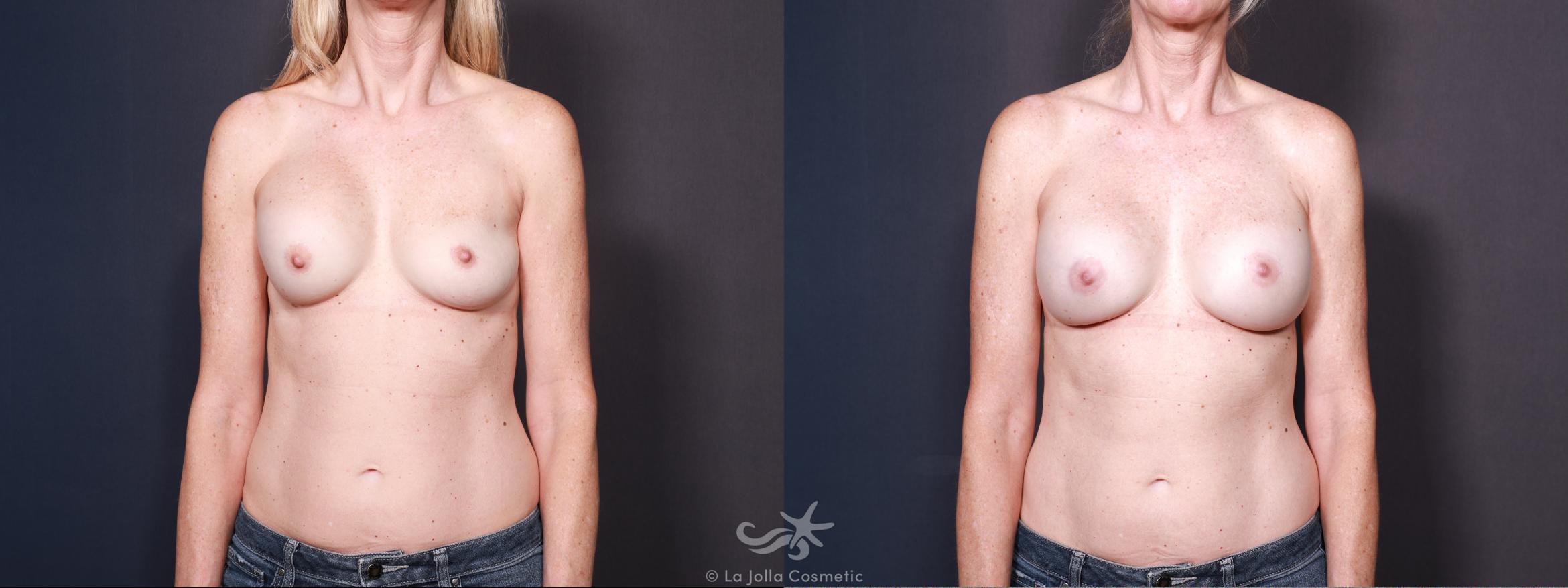 Before & After Revision Breast Surgery Result 618 Front View in San Diego, CA