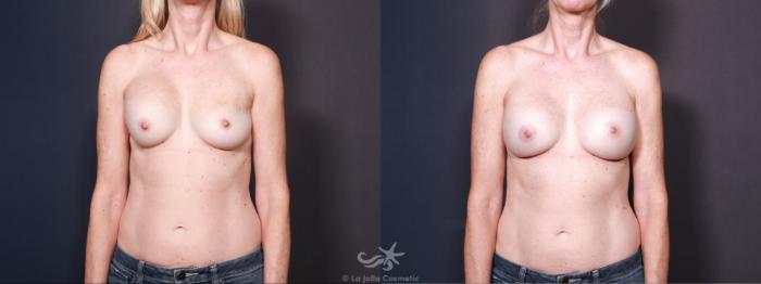 Before & After Breast Implant Replacement Result 618 Front View in San Diego, Carlsbad, CA