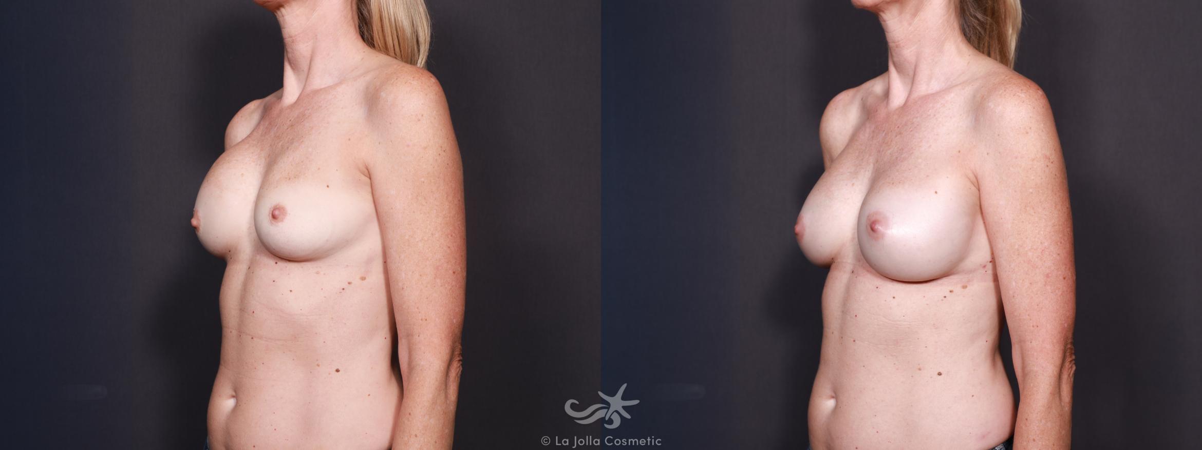 Before & After Breast Implant Replacement Result 618 Right Side View in San Diego, CA