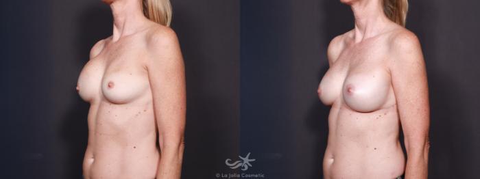 Before & After Breast Implant Replacement Result 618 Right Side View in San Diego, Carlsbad, CA