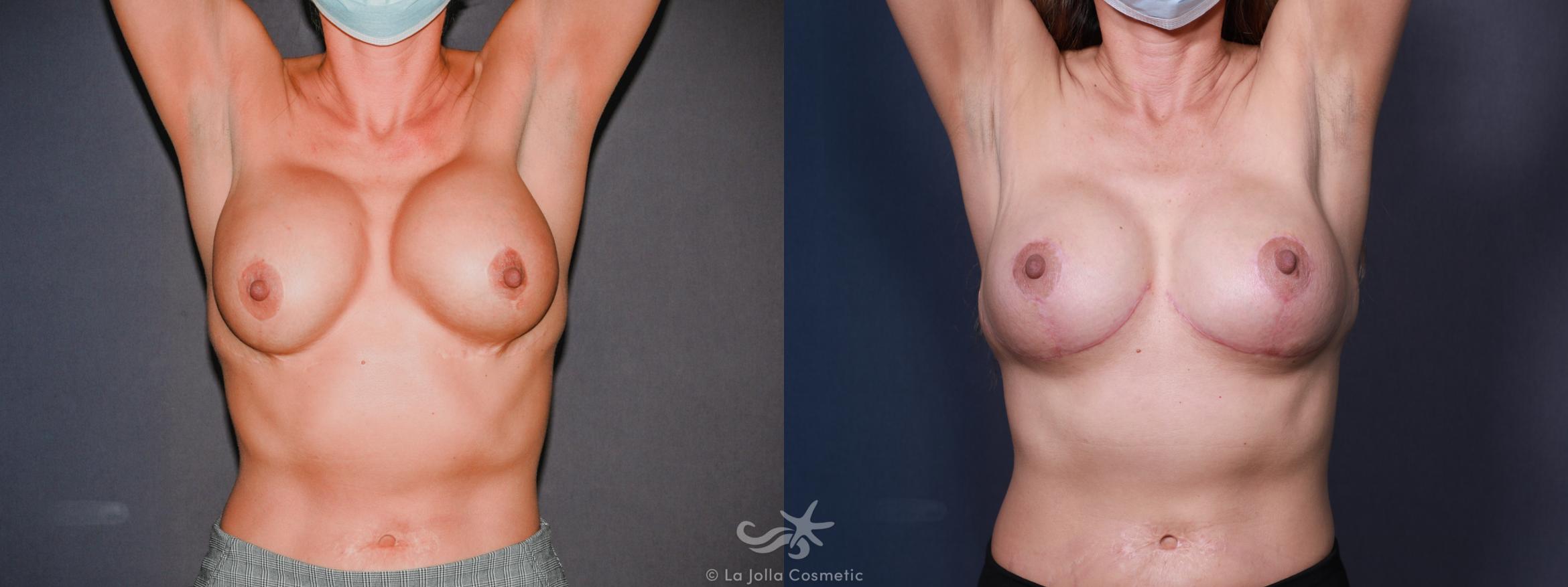 Before & After Breast Implant Replacement Result 621 Front View in San Diego, CA