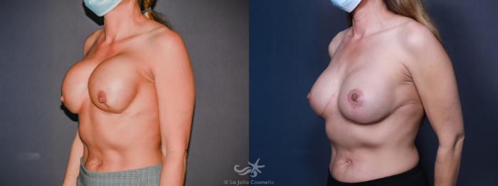 Before & After Breast Implant Replacement Result 621 Left Oblique View in San Diego, Carlsbad, CA