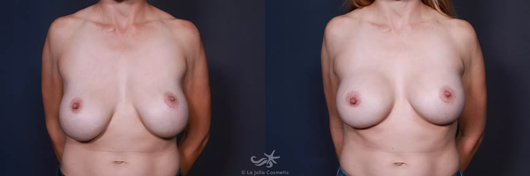 Before & After Breast Implant Replacement Result 67 Front View in San Diego, CA