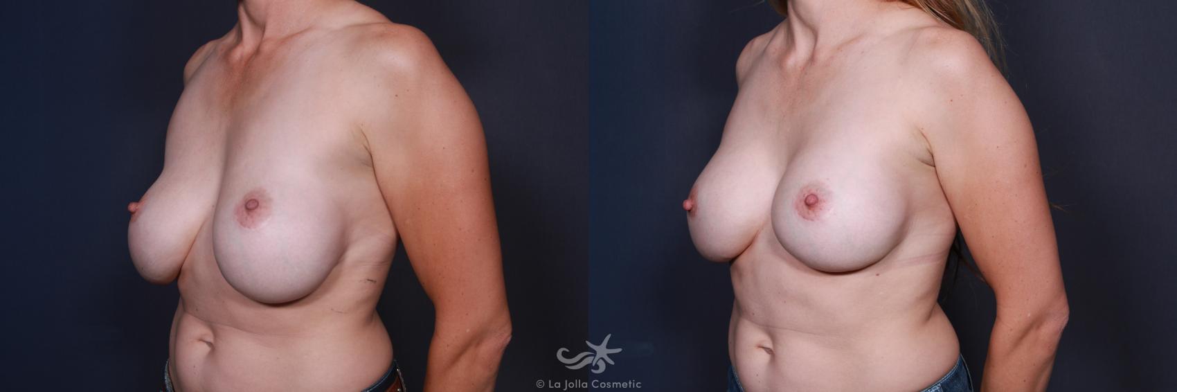 Before & After Breast Implant Replacement Result 67 Left Oblique View in San Diego, CA