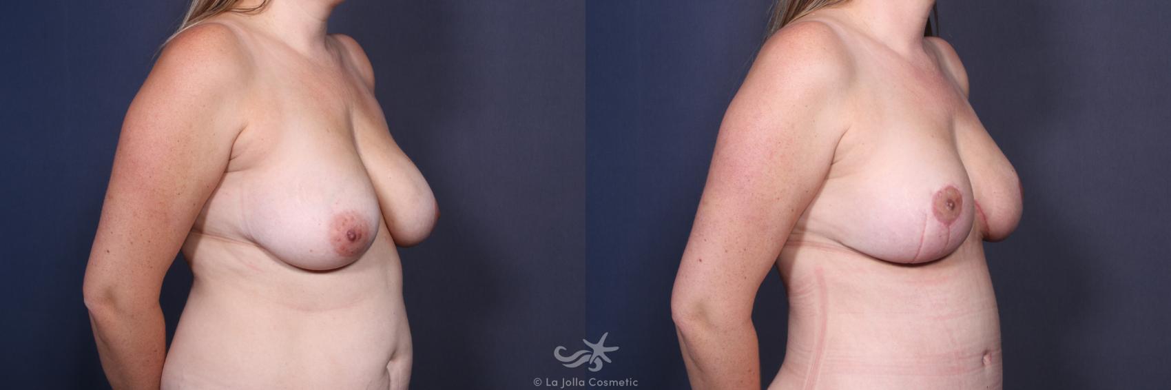 Before & After Breast Lift Result 124 Right Oblique View in San Diego, CA