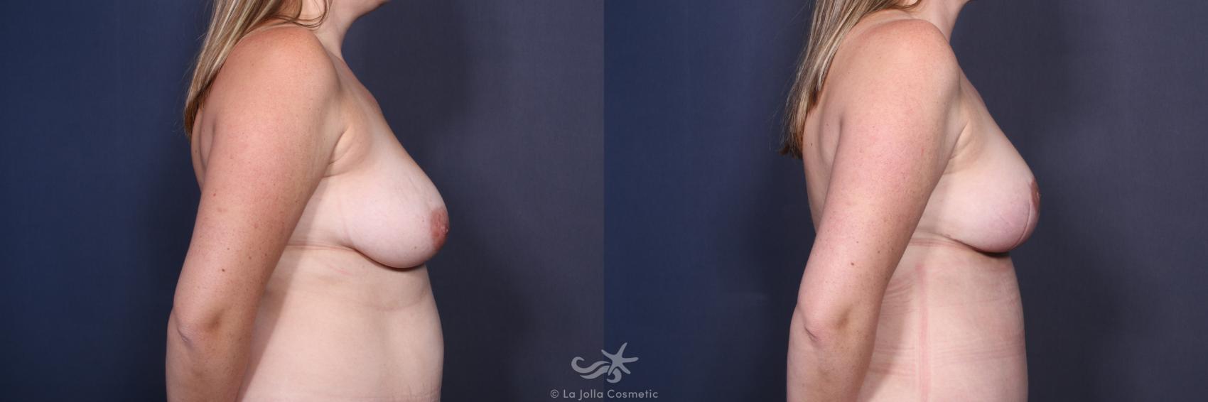 Before & After Breast Lift Result 124 Right Side View in San Diego, CA