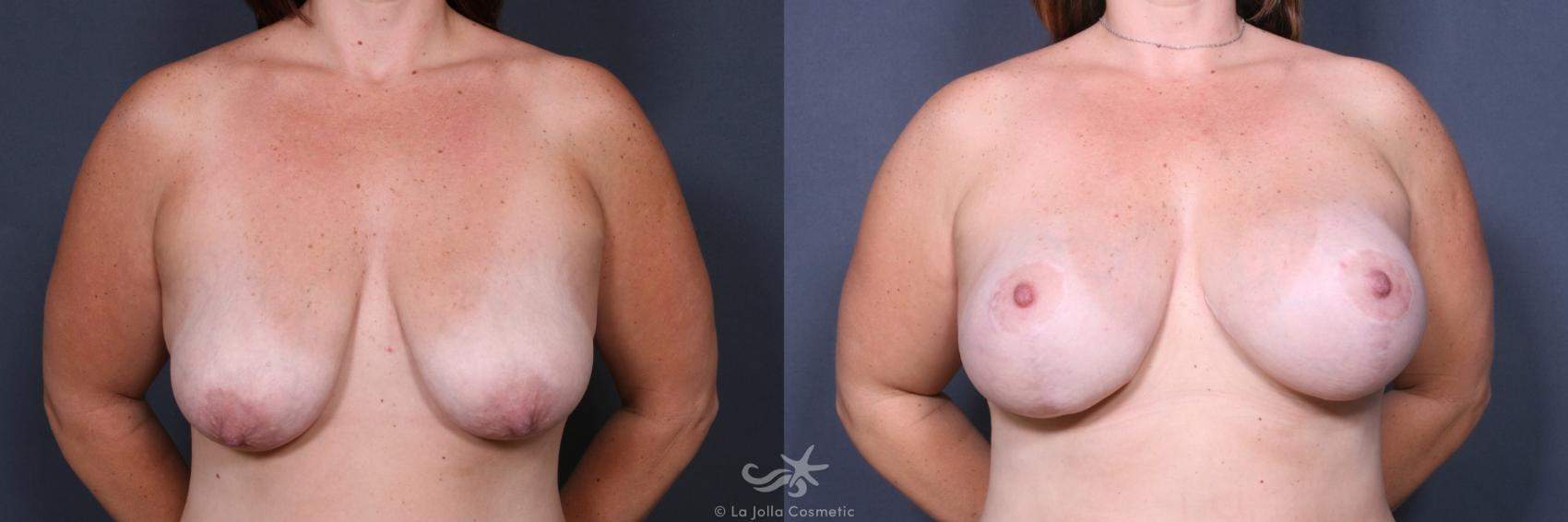 Before & After Breast Lift Result 322 Front View in San Diego, CA