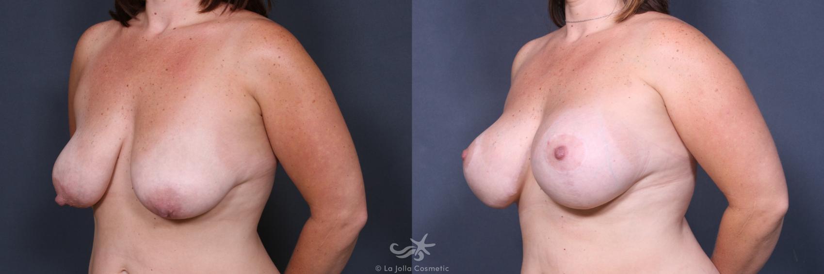 Before & After Breast Lift Result 322 Left Oblique View in San Diego, CA