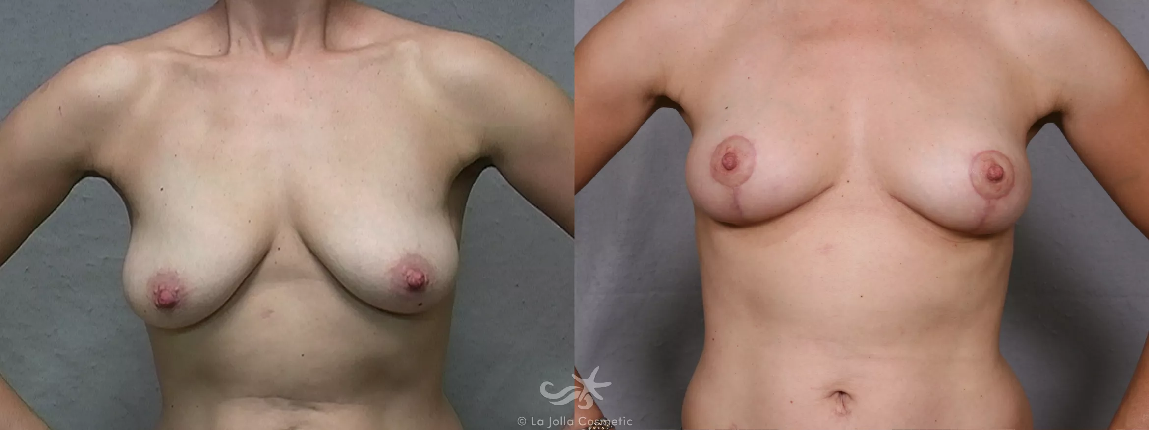 Before & After Breast Lift Result 453 Front View in San Diego, CA