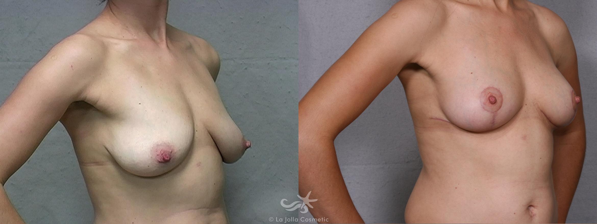 Before & After Breast Lift Result 453 Right Oblique View in San Diego, CA