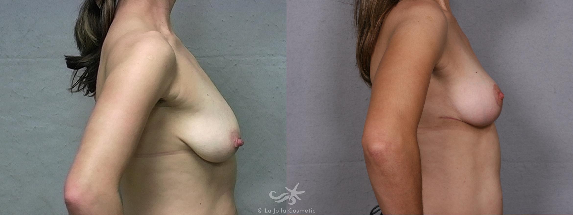 Before & After Breast Lift Result 453 Right Side View in San Diego, CA