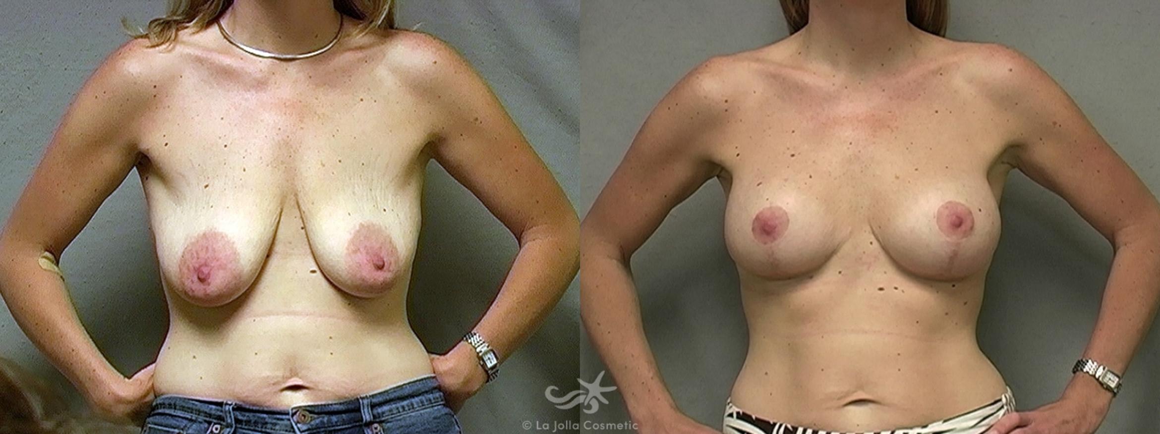 Before & After Breast Lift Result 455 Front View in San Diego, CA