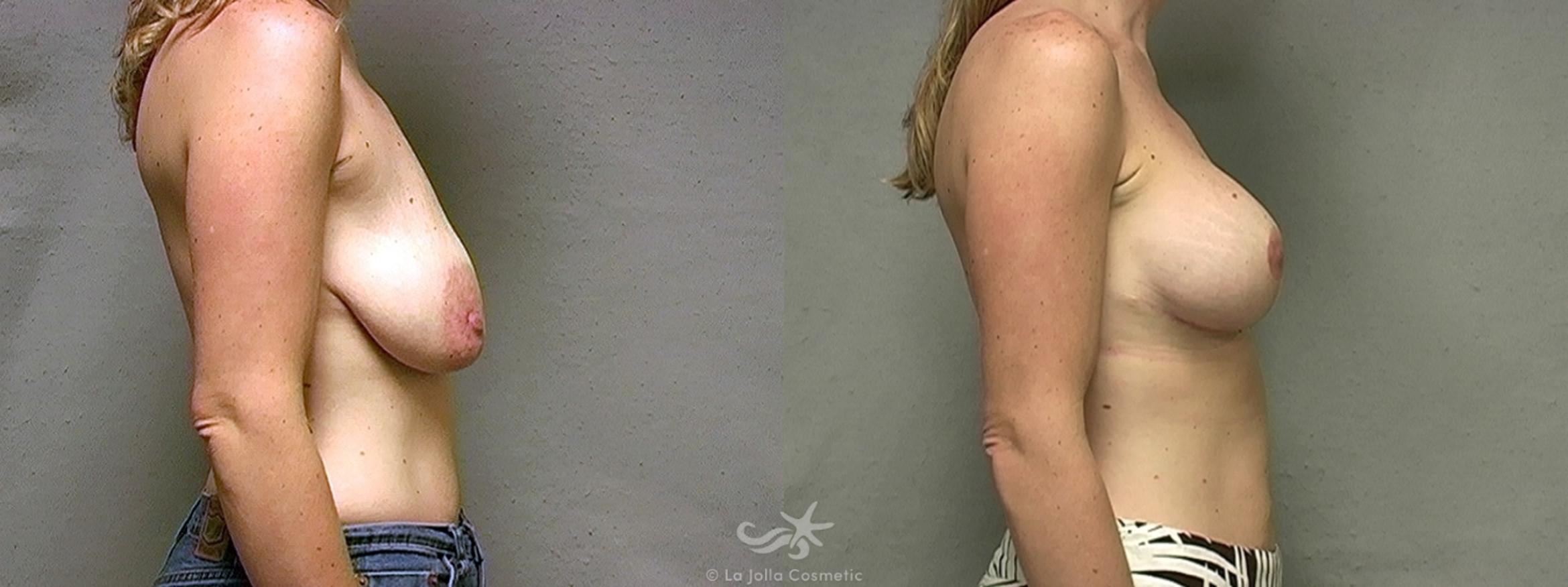 Before & After Breast Lift Result 455 Right Side View in San Diego, CA