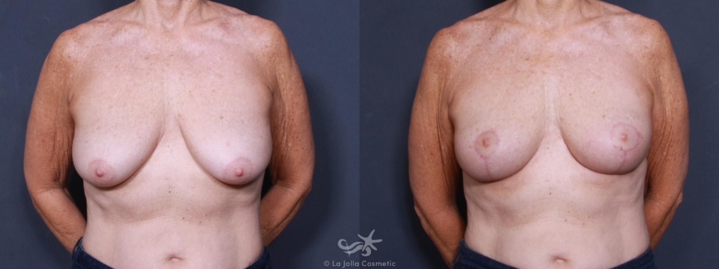Before & After Breast Lift Result 459 Front View in San Diego, CA