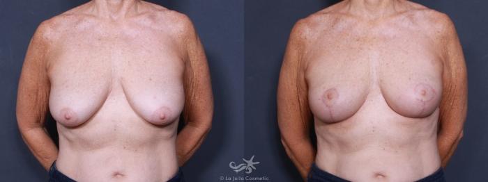 Before & After Breast Lift Result 459 Front View in San Diego, Carlsbad, CA