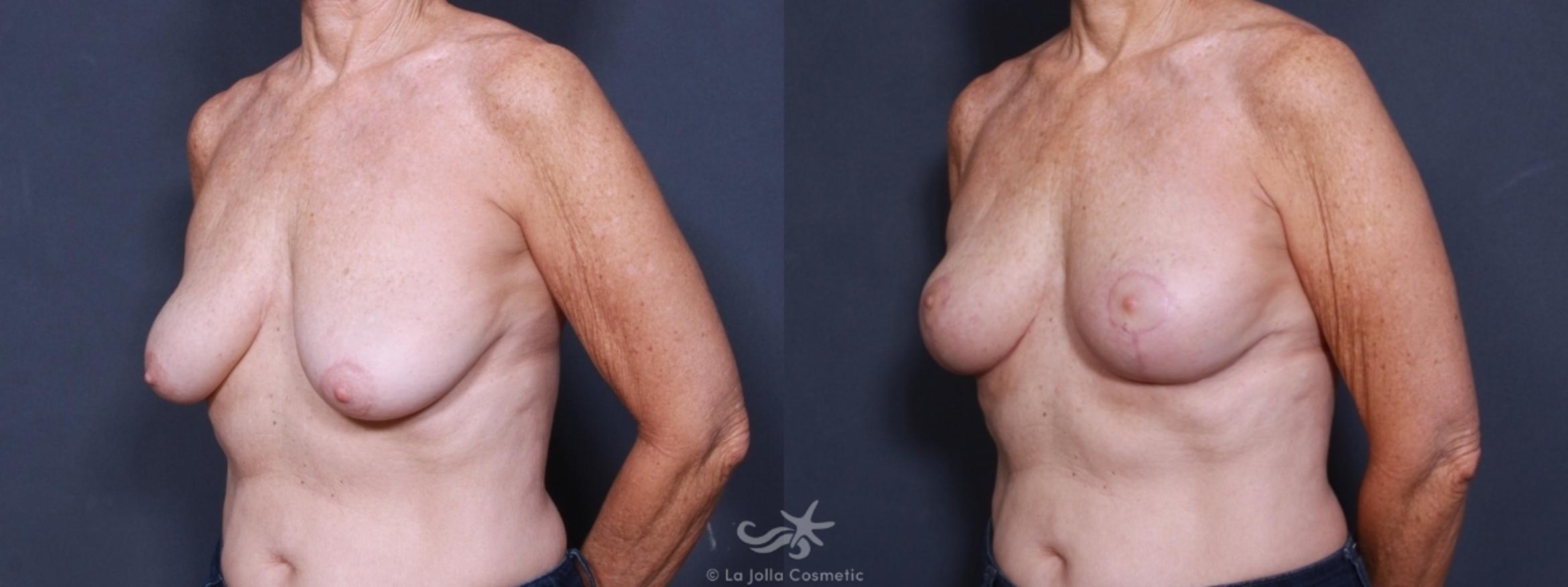Before & After Breast Lift Result 459 Left Oblique View in San Diego, CA