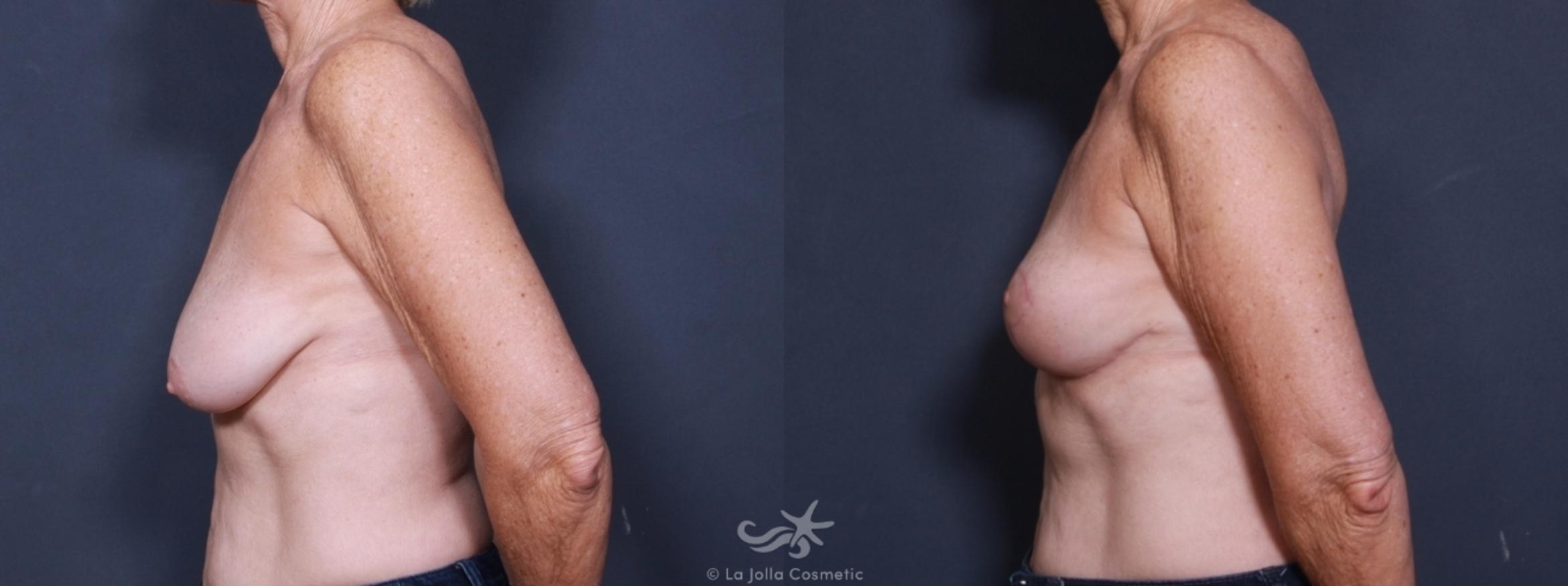 Before & After Breast Lift Result 459 Left Side View in San Diego, CA