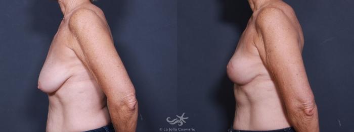 Before & After Breast Lift Result 459 Left Side View in San Diego, Carlsbad, CA