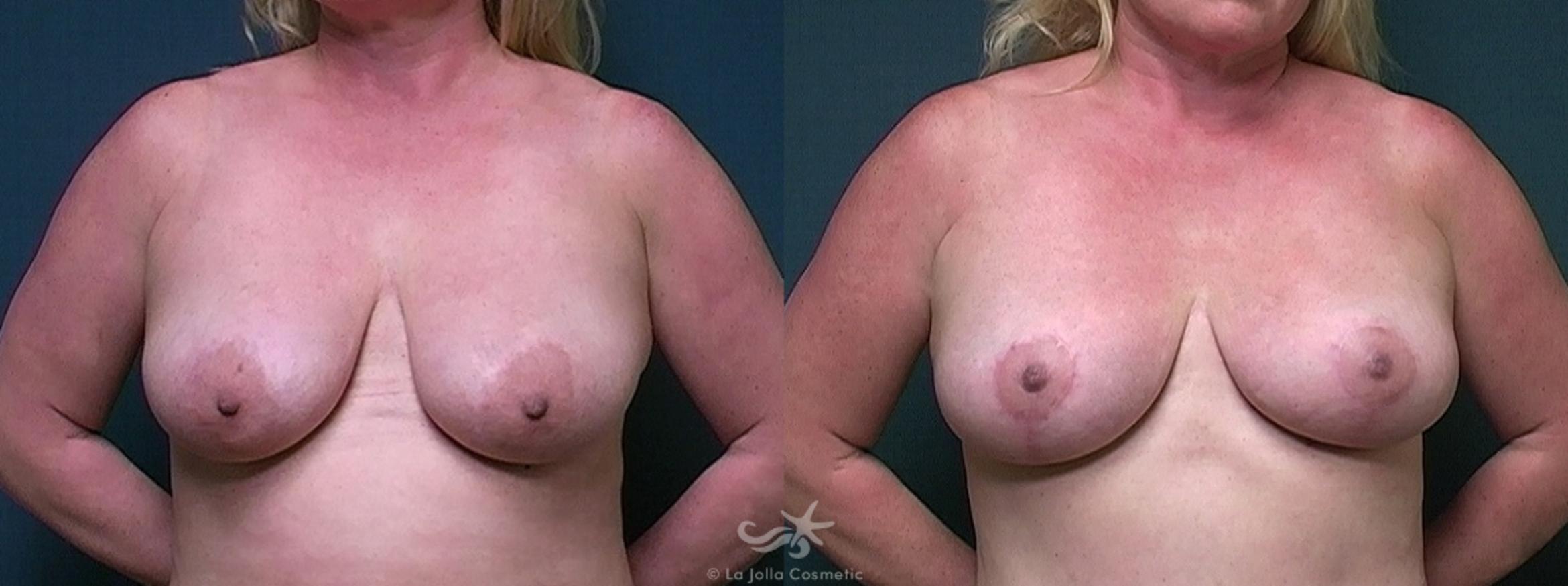 Before & After Breast Lift Result 470 Front View in San Diego, CA
