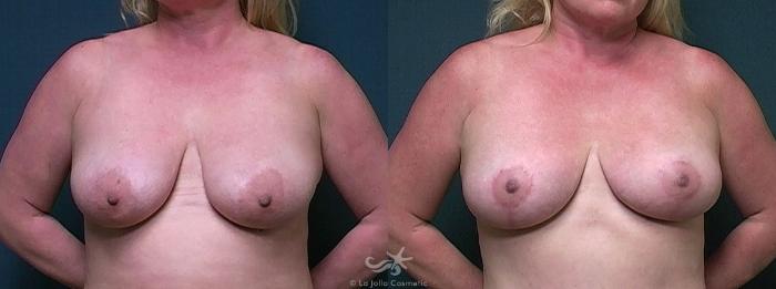 Before & After Breast Lift Result 470 Front View in San Diego, Carlsbad, CA