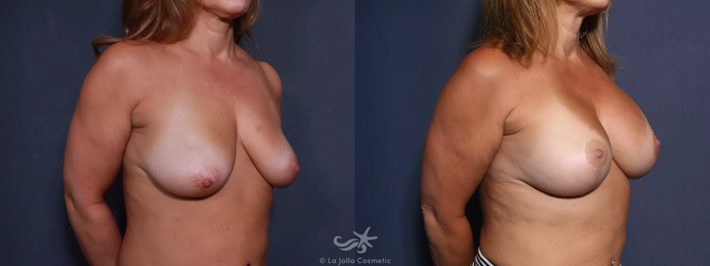 Before & After Breast Lift Result 494 Right Oblique View in San Diego, CA
