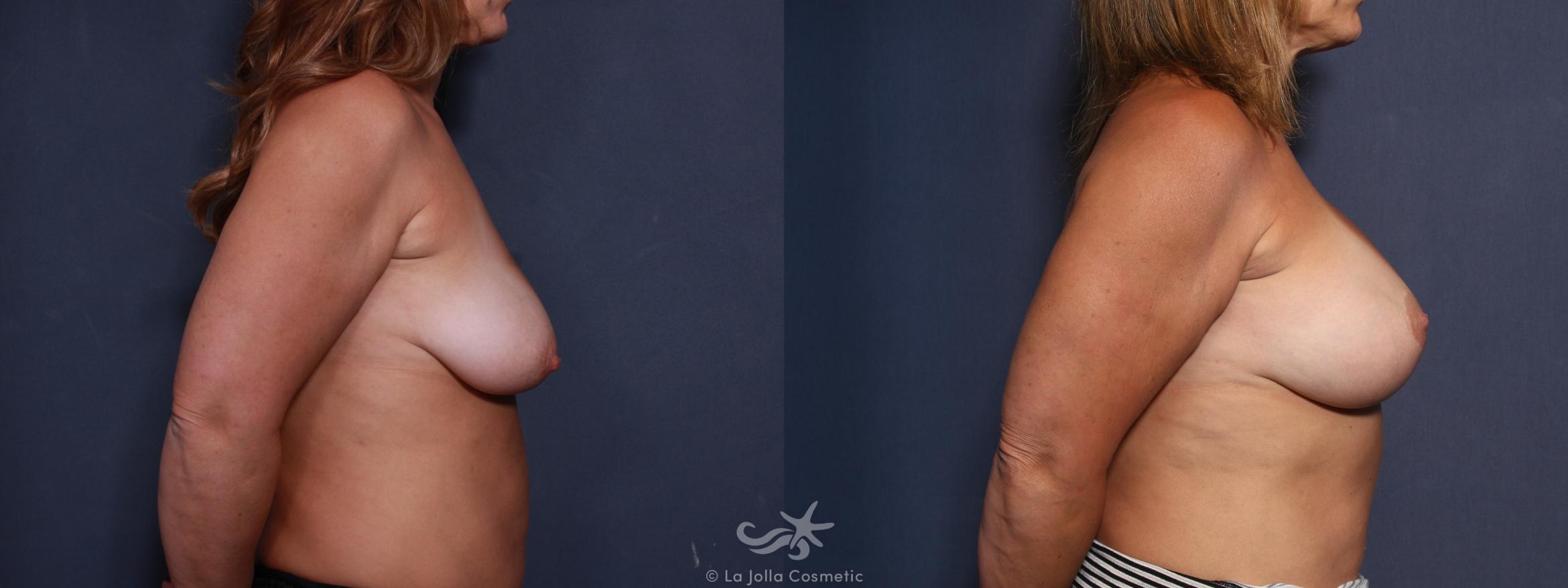 Before & After Breast Lift Result 494 Right Side View in San Diego, CA