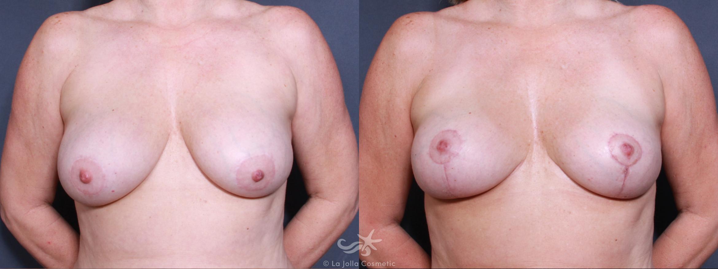 Before & After Breast Lift Result 497 Front View in San Diego, CA