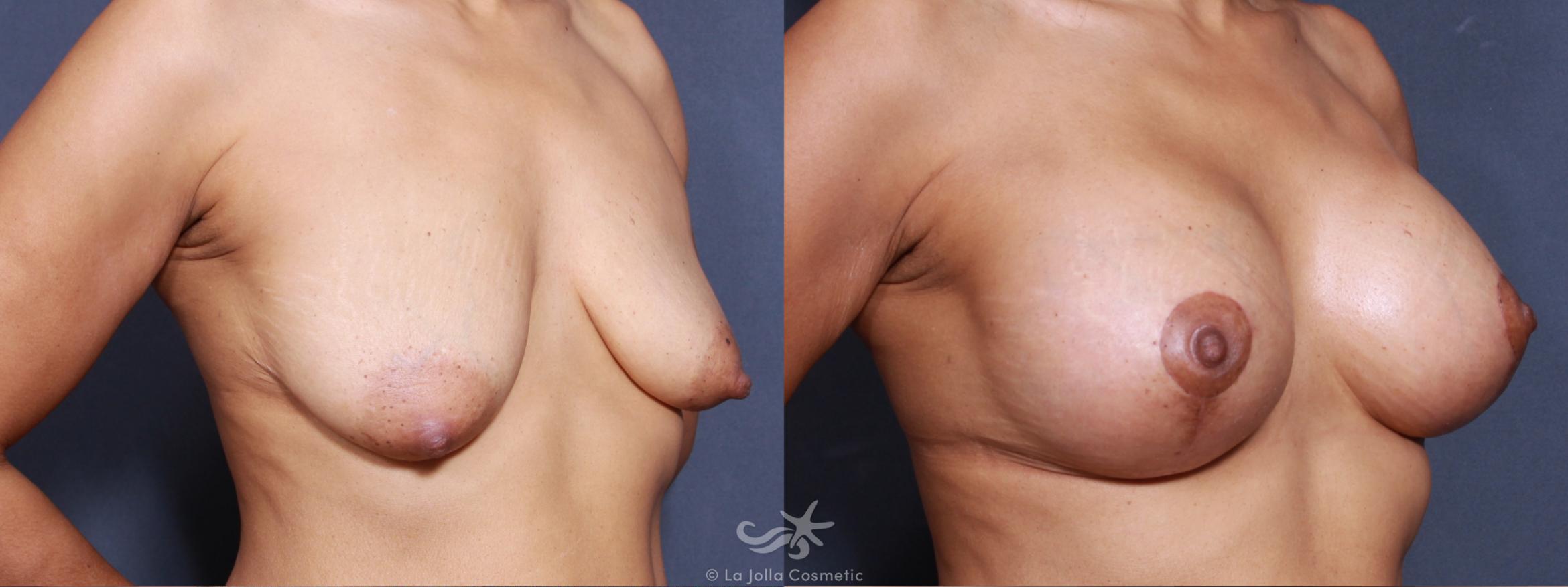 Before & After Breast Lift Result 500 Right Oblique View in San Diego, CA