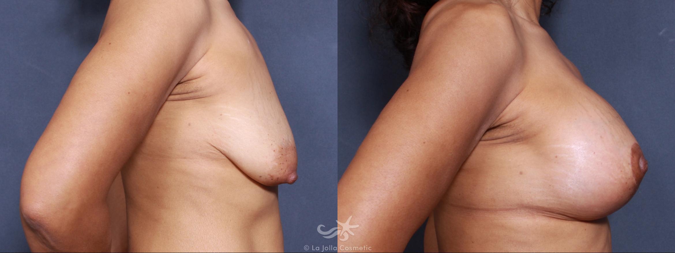 Before & After Breast Lift Result 500 Right Side View in San Diego, CA