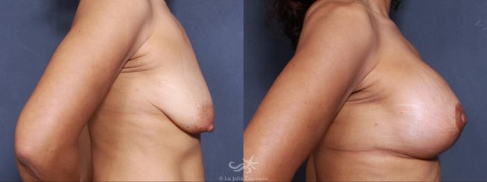 Before & After Breast Lift Result 500 Right Side View in San Diego, Carlsbad, CA