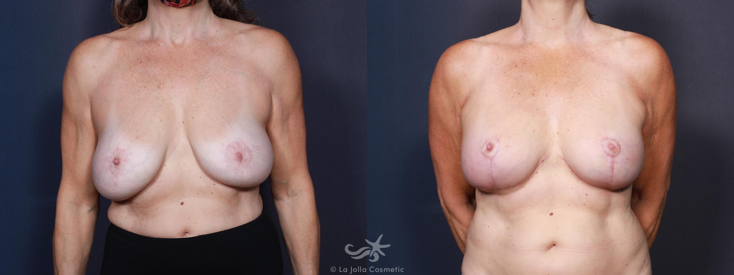 Before & After Breast Lift Result 634 Front View in San Diego, CA