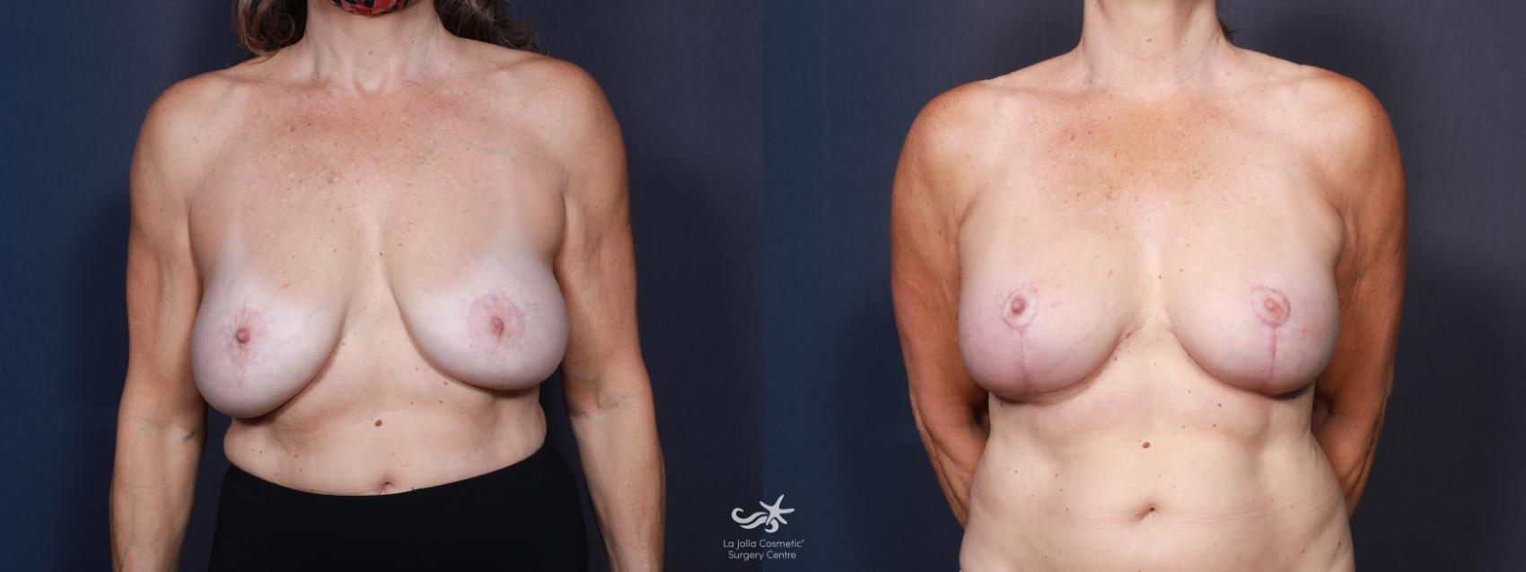 Before & After Breast Lift Result 634 Front View in San Diego, CA