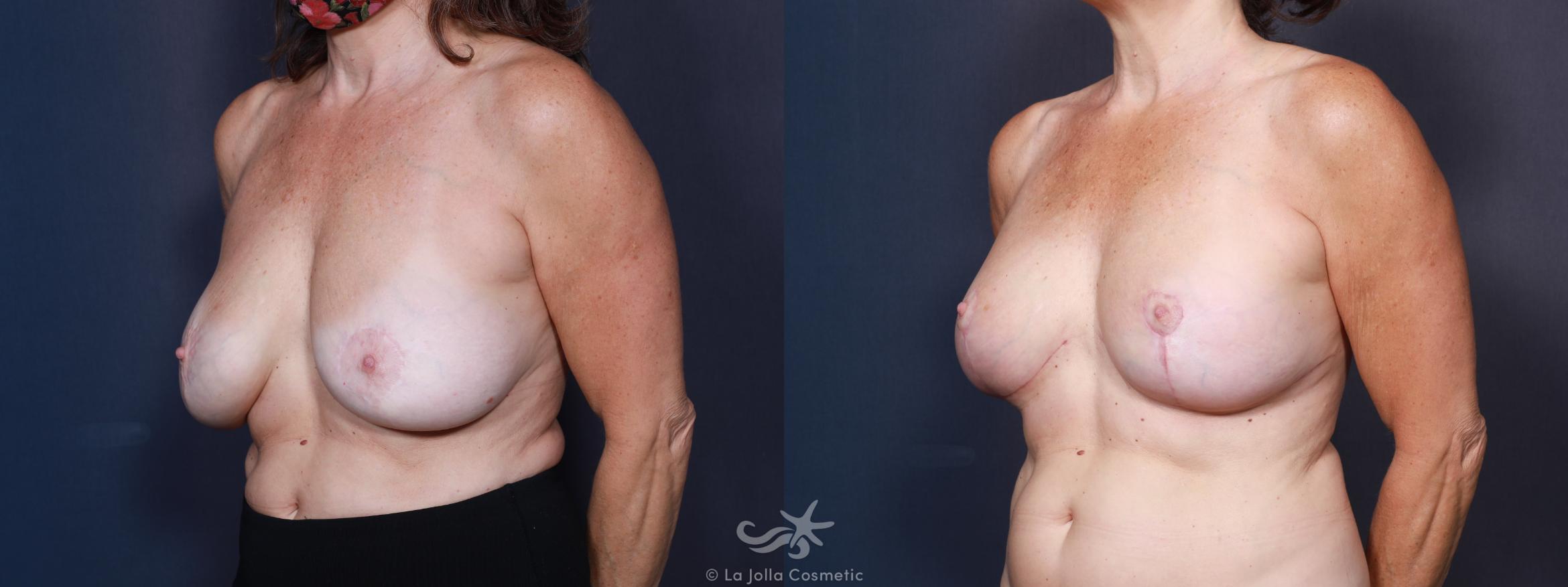 Before & After Breast Lift Result 634 Left Oblique View in San Diego, CA