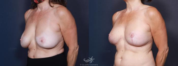 Before & After Breast Lift Result 634 Left Oblique View in San Diego, Carlsbad, CA